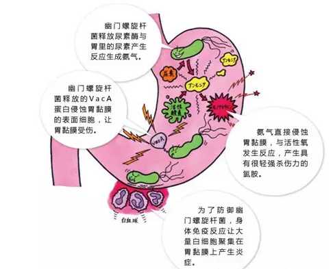 保“胃”健康，愛在行動 ——南丹縣人民醫(yī)院幽門螺桿菌及消化道疾病義診活動