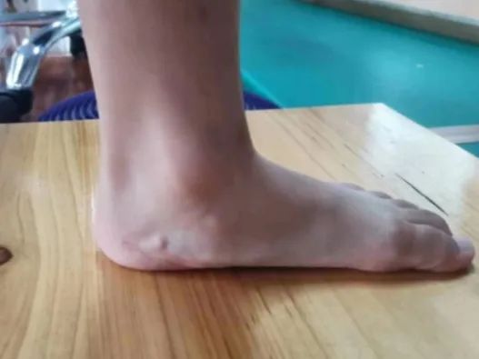 【健康科普】不容小覷的“體態(tài)殺手”——扁平足