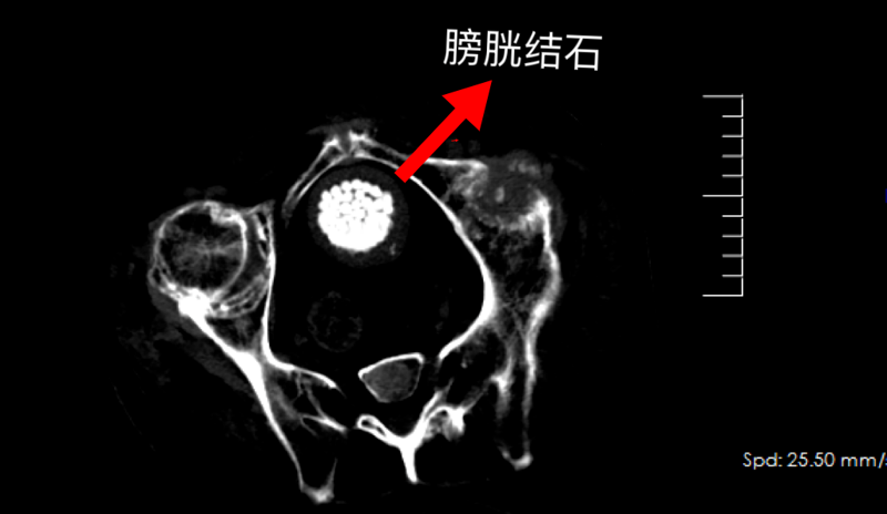 【專科技術(shù)】“鏡”到石除！我院泌尿外科在男子體內(nèi)取出300多顆結(jié)石！